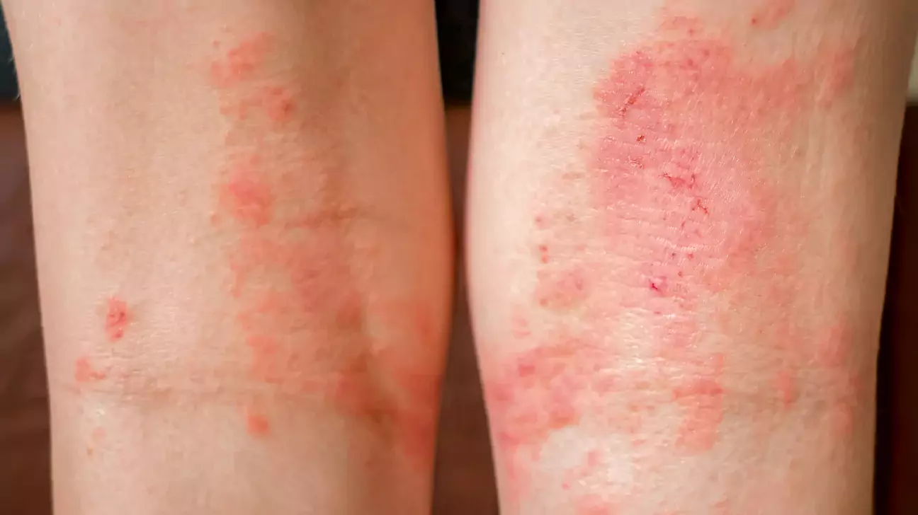 Dermatitis Bersisik Superfisial Kronis dan Perbedaannya dengan Psoriasis