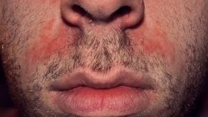 Hati-hati Dermatitis Aktinik Kronis, Iritasi Kulit Menahun karena Sinar Matahari