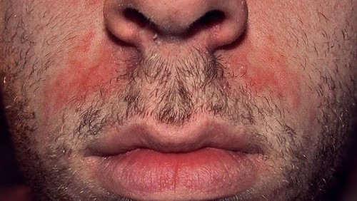 Hati-hati Dermatitis Aktinik Kronis, Iritasi Kulit Menahun karena Sinar Matahari