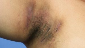 Hidradenitis Suppurativa, Penyebab, Gejala, dan Dampaknya pada Kualitas Hidup
