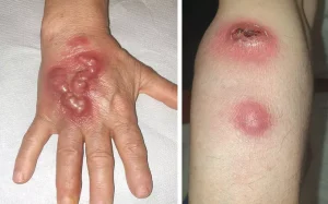 Infeksi Limfokutan Sporotrichoid, ketika infeksi kulit menyebar mengikuti Limfa