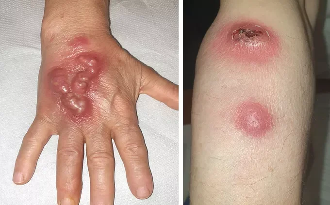 Infeksi Limfokutan Sporotrichoid, ketika infeksi kulit menyebar mengikuti Limfa