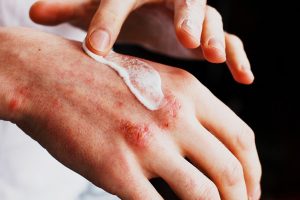 Inilah Eksim Herpetikum, Infeksi Kulit Yang Bisa Menjadi Darurat Medis