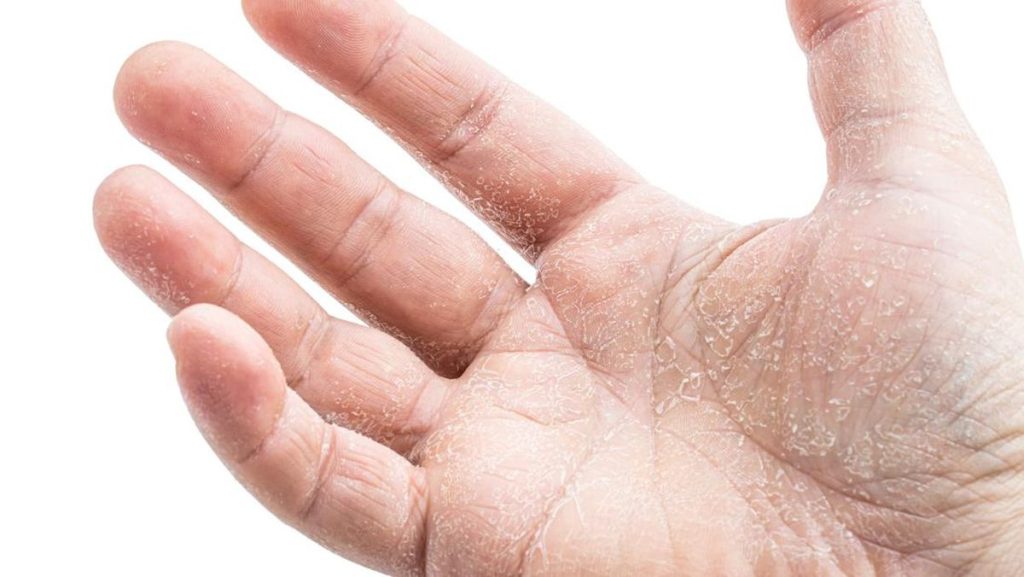 Keratolysis Exfoliativa pada Telapak Tangan, Apakah ini Berbahaya?