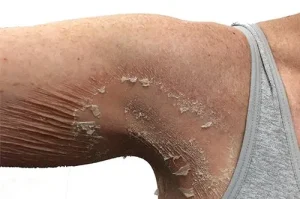 Kondisi Kulit Tidak Menular yang Sering Terabaikan, Inilah Parakeratosis Granular
