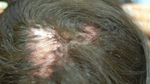 Memahami Folliculitis Decalvans, Penyebab Rambut Rontok Berbekas