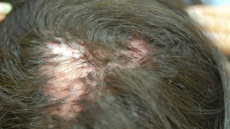 Memahami Folliculitis Decalvans, Penyebab Rambut Rontok Berbekas