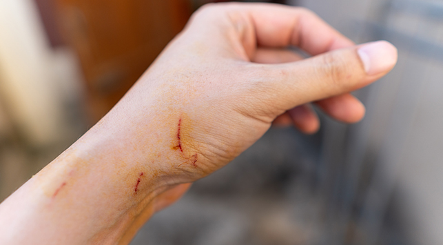 Mengenal Cat Scratch Disease (CSD), Penyakit dari Cakaran Kucing