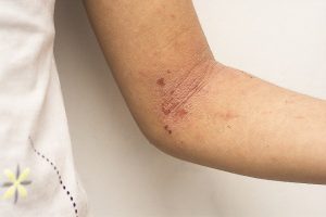 Mengenal Dermatitis Bersisik Superfisial Kronis, Peradangan Kulit Jangka Panjang