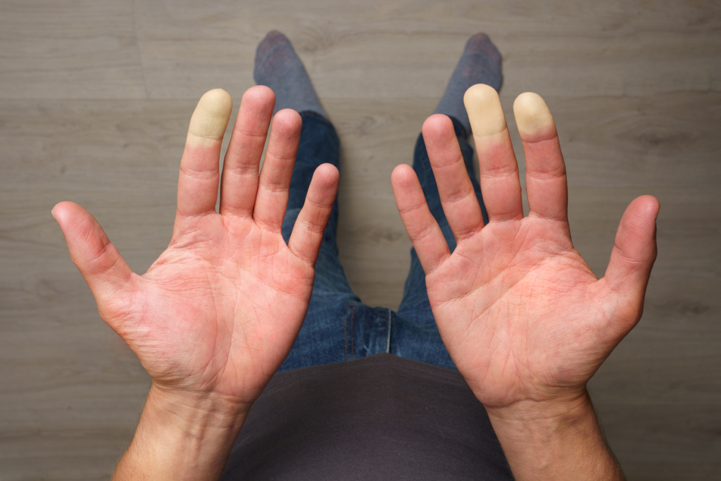 Mengenal Fenomena Raynaud, Kondisi Pembuluh Darah yang Sensitif