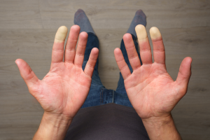 Mengenal Fenomena Raynaud, Kondisi Pembuluh Darah yang Sensitif