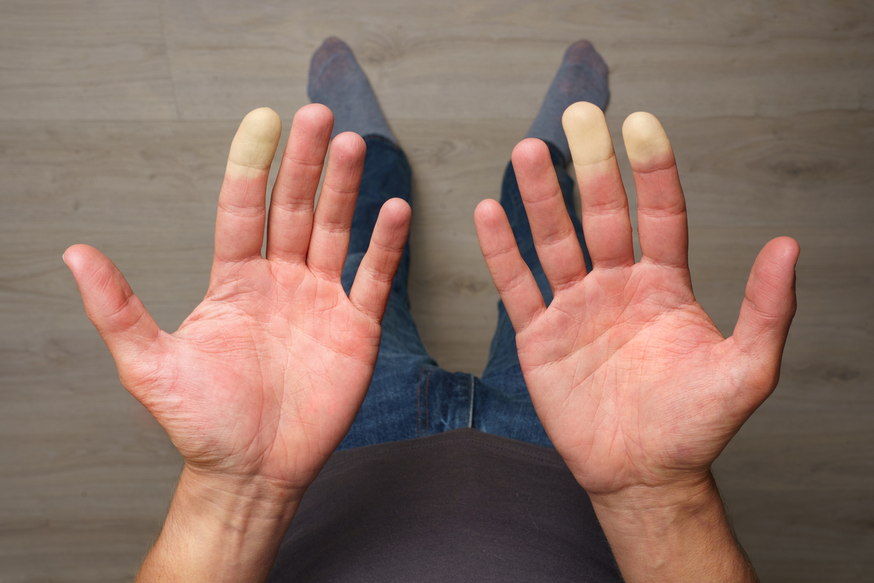 Mengenal Fenomena Raynaud, Kondisi Pembuluh Darah yang Sensitif