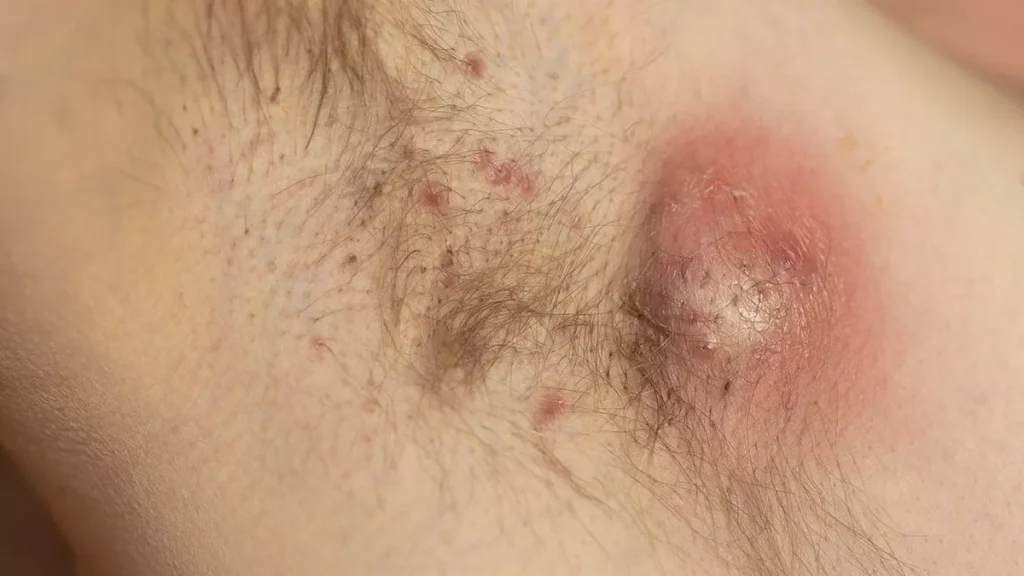 Mengenal Hidradenitis Suppurativa, Penyakit Kulit Kronis yang Sering Disalahartikan Bisul
