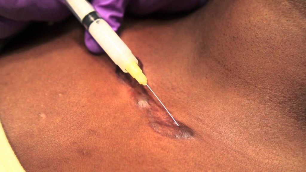 Mengenal Intralesional Steroid Injection dalam Penanganan Kelainan Kulit