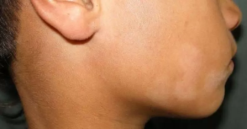 Mengenal Pityriasis Alba, Masalah Kulit Ringan yang Sering Disalahartikan