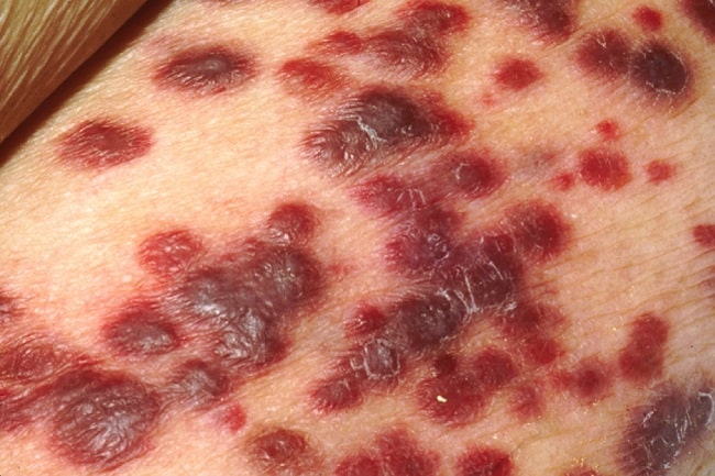 Mengenal Sarkoma Kaposi, Tumor Kulit yang Sering Muncul pada Imun Lemah