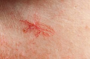 Mengenal Telangiektasia Garis Merah Halus pada Wajah dan Kaki yang Tampak Dipermukaan Kulit