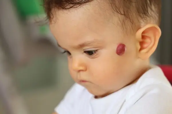 Mengenal Xanthogranuloma Juvenil, Tumor Kulit Jinak pada Bayi dan Anak