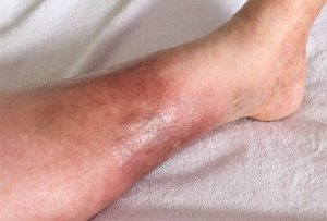 Waspadai Selulitis Eosinofilik, Saat Ruam Kulit Bukan Selulitis Biasa
