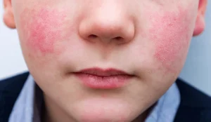 Akrodermatitis Papular pada Masa Kanak-Kanak dan Risikonya