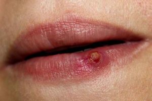Granuloma Piogenik di Jari dan Wajah, Kenapa Bisa Muncul?