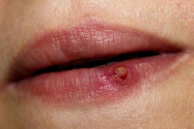 Granuloma Piogenik di Jari dan Wajah, Kenapa Bisa Muncul?