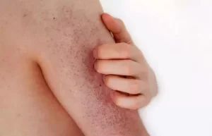 Keratosis Pilaris Saat Remaja, Mengapa Sering Muncul di Masa Puber