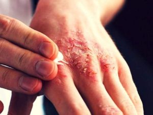 Kudis Berkerak pada Lansia dan Orang dengan Daya Tahan Tubuh Lemah
