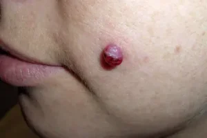 Mengatasi Granuloma Piognetik di Jari dan Wajah dengan Cepat dan Tepat