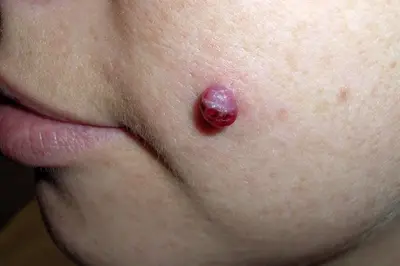 Mengatasi Granuloma Piognetik di Jari dan Wajah dengan Cepat dan Tepat