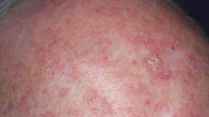 Mengatasi Ruam Dermatosis Akantolitik Transien dengan cara yang Tepat