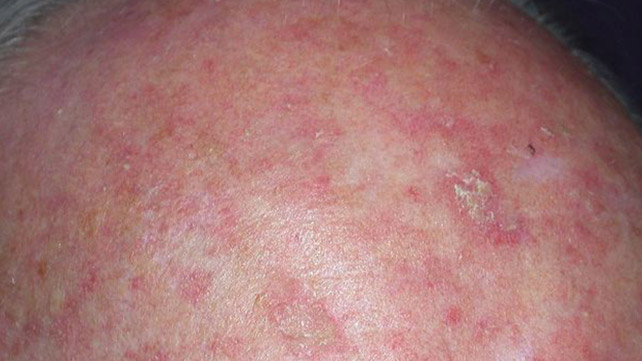 Mengatasi Ruam Dermatosis Akantolitik Transien dengan cara yang Tepat