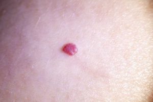 Mengenal Angioma Ceri, Benjolan Merah Kecil pada Permukaan Kulit