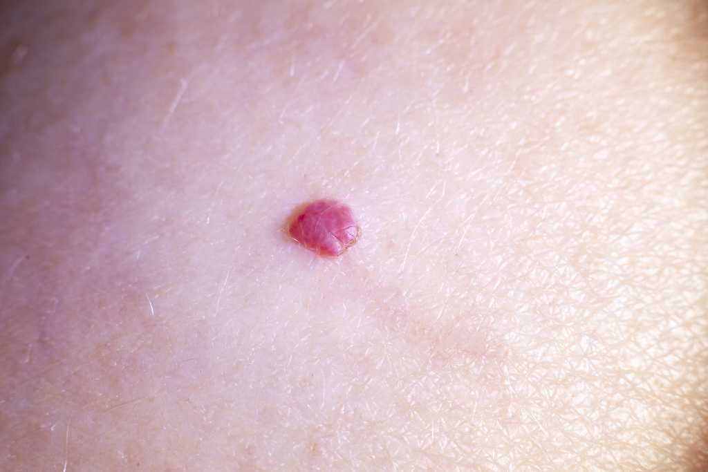 Mengenal Angioma Ceri, Benjolan Merah Kecil pada Permukaan Kulit