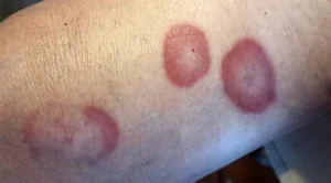 Mengenal Granuloma Annulare, Ruam Kulit Berbentuk Cincin