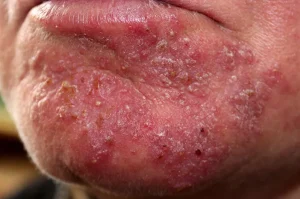 Tinea Barbae, Penyebab Ruam dan Gatal di Sekitar Janggut