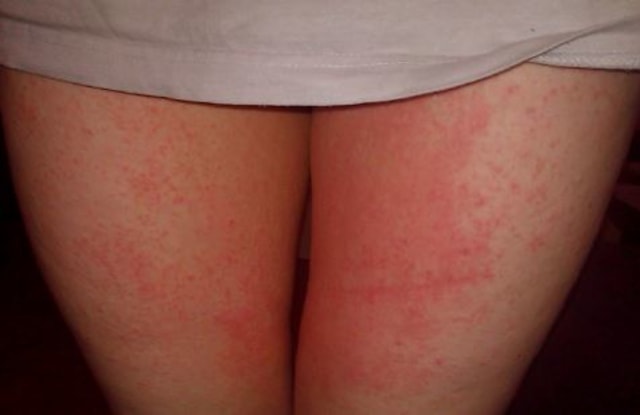 Tinea Cruris, Penyebab Gatal yang Membandel di Lipatan Paha