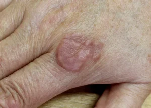 Pengobatan Alami untuk Granuloma Annulare, yang Berhasil