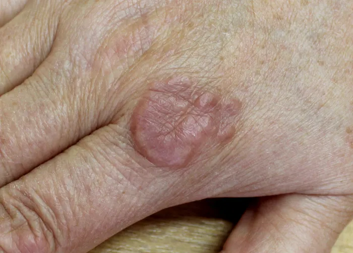Pengobatan Alami untuk Granuloma Annulare, yang Berhasil