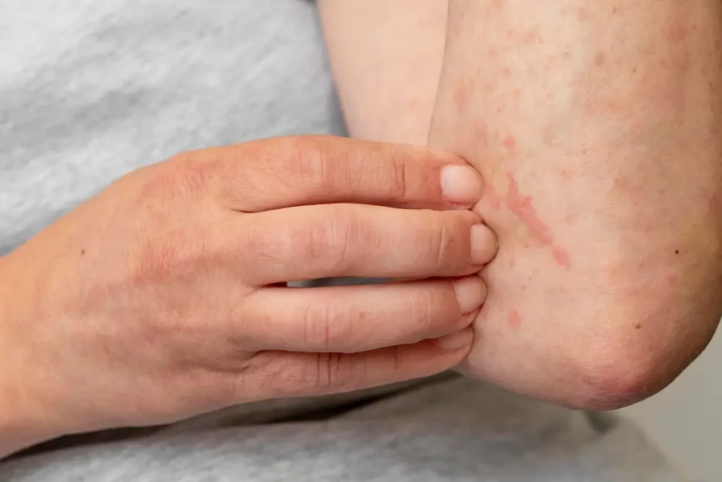 Penyebab Keratosis Pilaris dan Cara Mencegahnya