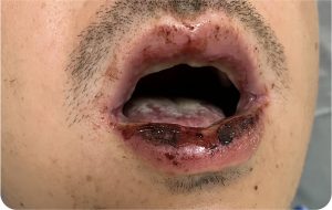 Ruam Mukokutan Infeksi Reaktif Dipicu Saluran Napas Gangguan