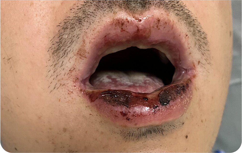Ruam Mukokutan Infeksi Reaktif Dipicu Saluran Napas Gangguan
