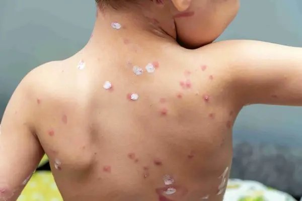 Scabies, Penyakit Menular pada Kulit yang perlu Diwaspadai dan cara Mengobatinya