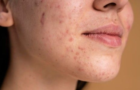Tinea Incognito, Dampak Penggunaan Obat Kulit Sembarangan
