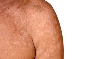 Tinea Versicolor, Penyakit Kulit tidak Menular Namun Perlu Diwaspadai
