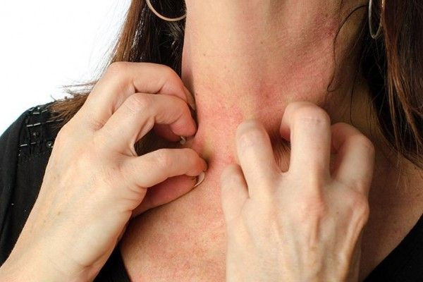Anafilaksis dan Alergi Makanan, Inilah cara Menghindari Reaksi Berbahaya