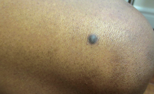 Dermatofibroma pada Kaki dan Tangan, Penyebab Berbahayanya