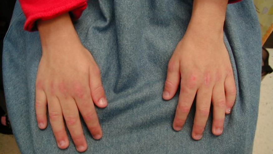 Dermatomiositis Juvenil, Penyakit yang dapat Diobati dengan tepat