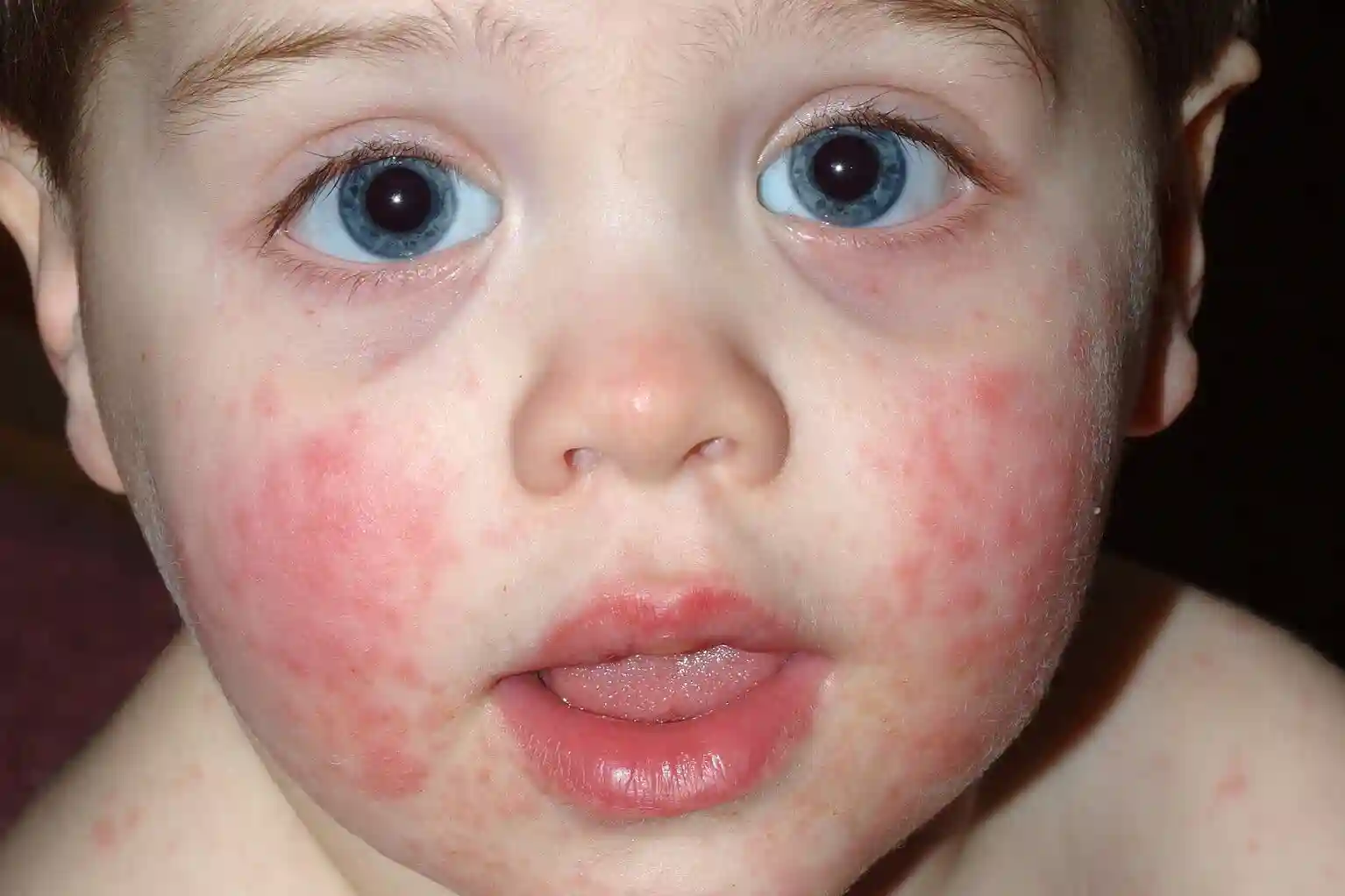 Eritema Infekksiosa VS Impetigo, Perbedaan Pipi Merah Menular
