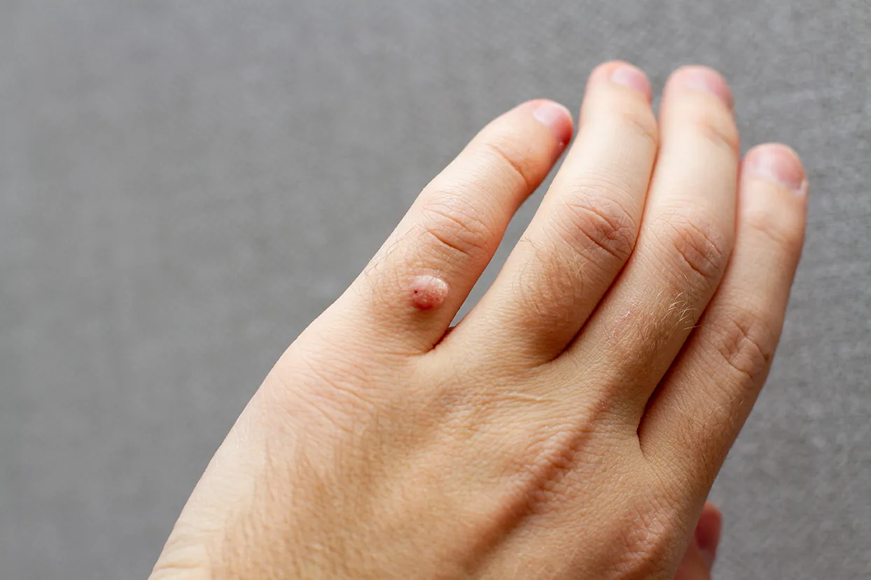 Faktor Risiko dan Pencegahan Dermatofibroma Pada Kaki&Tangan